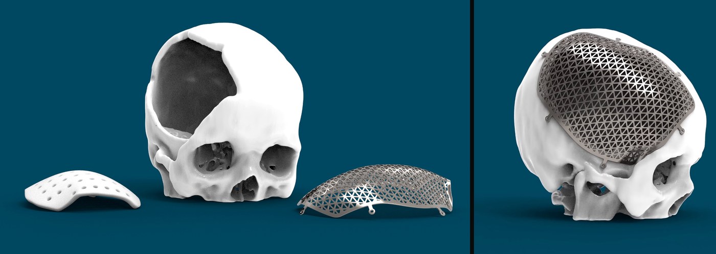 Patient-specific cranial implant designed by PSH Design: a reconstructed skull defect shown with a solid plate and a lattice plate option, and the lattice implant located in place